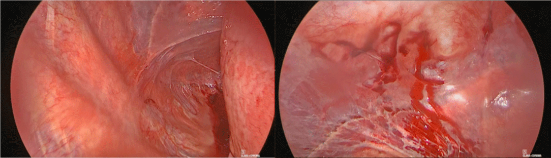 A case report of thoracic endometriosis – A rare cause of